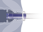 DIARFLEX® Pro Stuhldrainagesystem – Image 2